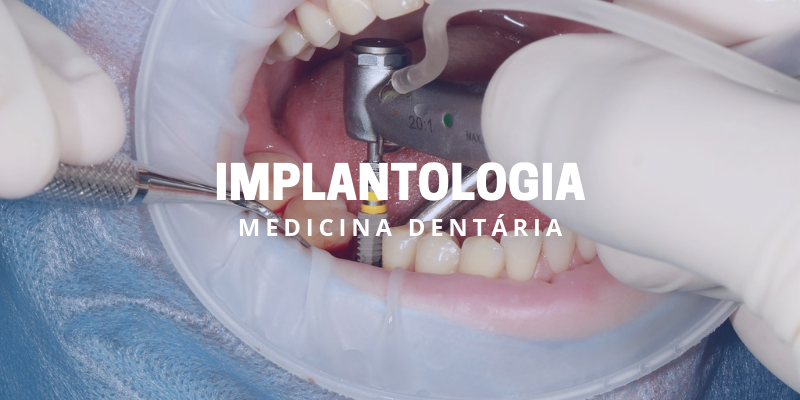 implantologia, Clínica Dentária Rosário Saramago, Dentista Entroncamento